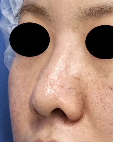 鼻尖縮小、鼻孔縁延長　６ヶ月後　左斜めのBefore写真