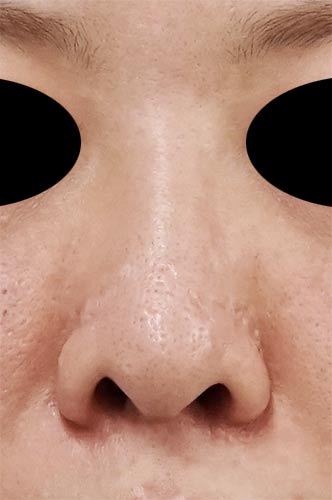 鼻尖縮小、鼻孔縁延長　６ヶ月後　正面のBefore写真