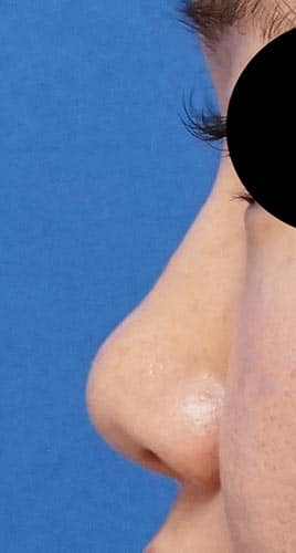 小鼻縮小（内側＋外側）、鼻尖縮小、軟骨移植　３ヶ月後　左側面のBefore写真
