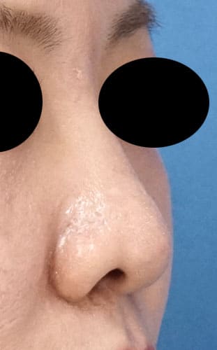 鼻尖縮小、鼻孔縁延長　６ヶ月後　右斜めのAfterの写真