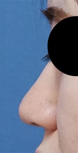 オステオポール除去、鼻尖縮小、軟骨移植、ストラット　3か月後　左側面のBefore写真