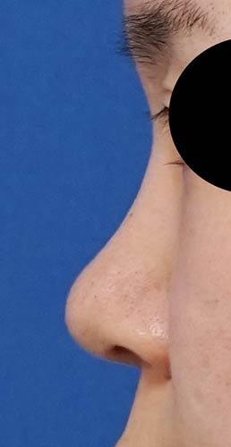 鼻尖縮小、軟骨移植　３ヶ月後　左側面のBefore写真