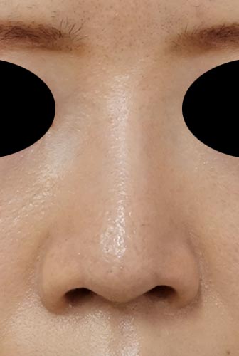 鼻Ｉ型プロテーゼ　半年後　正面のAfterの写真