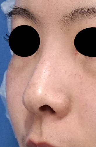 鼻尖縮小、鼻孔縁延長　１ヶ月後　左斜めのBefore写真