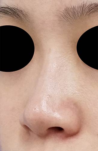 鼻ヒアルロン酸（クレヴィエルコントア）　３週間後　左斜めのAfterの写真