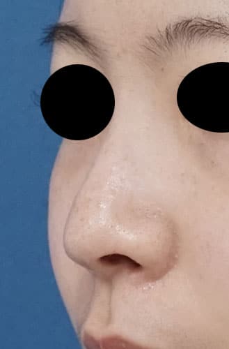 鼻尖縮小、鼻孔縁延長　１ヶ月後　左斜めのAfterの写真