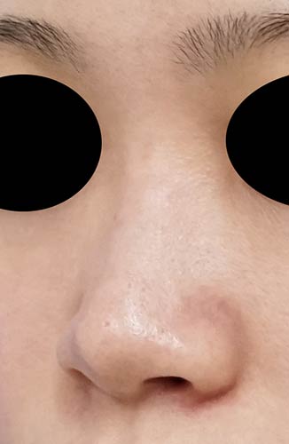 鼻ヒアルロン酸（クレヴィエルコントア）　３週間後　左斜めのBefore写真