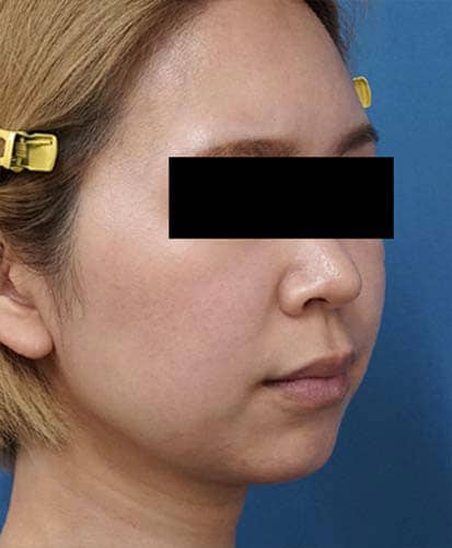小顔脂肪吸引（ホホ・アゴ下）　３ヶ月後　右斜めのAfterの写真
