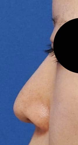 鼻Ｉ型プロテーゼ　半年後　左側面のBefore写真