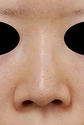 鼻Ｉ型プロテーゼ　半年後　正面のBefore写真