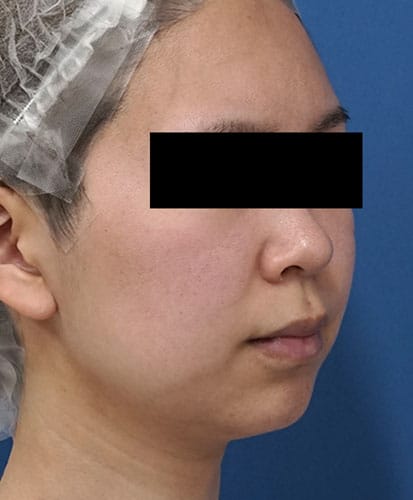 小顔脂肪吸引（ホホ・アゴ下）　３ヶ月後　右斜めのBefore写真