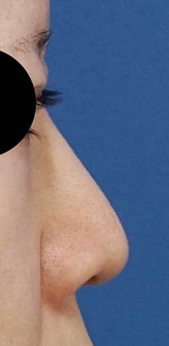 鼻Ｉ型プロテーゼ　半年後　右側面のBefore写真