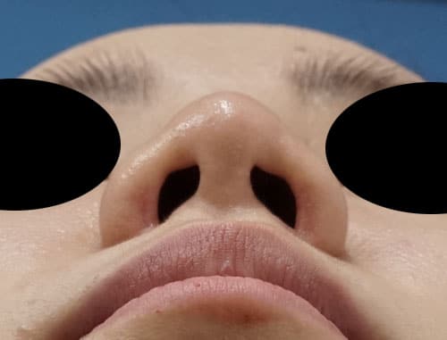 鼻孔縁挙上、鼻尖縮小（３D法）、ストラット、軟骨移植、プロテーゼ　１か月後　下からのAfterの写真