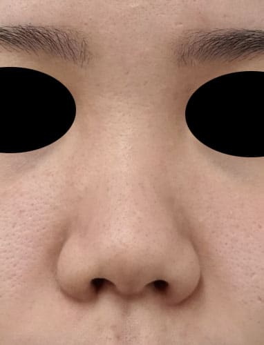 鼻孔縁挙上、鼻尖縮小（３D法）、ストラット、軟骨移植、プロテーゼ　１か月後　正面のBefore写真