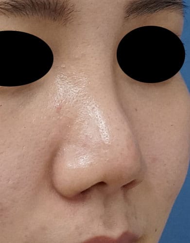 鼻孔縁挙上、鼻尖縮小（３D法）、ストラット、軟骨移植、プロテーゼ　１か月後　右斜めのAfterの写真