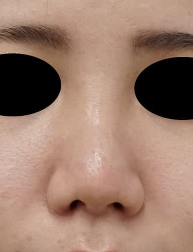 鼻孔縁挙上、鼻尖縮小（３D法）、ストラット、軟骨移植、プロテーゼ　１か月後　正面のAfterの写真