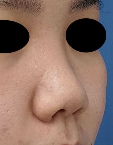 鼻孔縁挙上、鼻尖縮小（３D法）、ストラット、軟骨移植、プロテーゼ　１か月後　右斜めのBefore写真