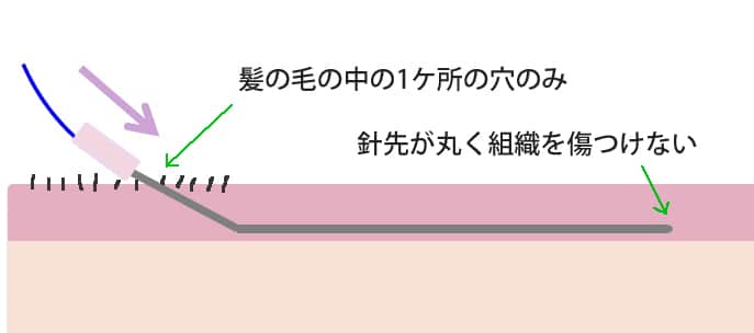 TEX3Dリフトの1か所の穴からの挿入イメージ