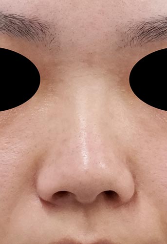 鼻翼縮小（内側＋外側）、鼻尖縮小、軟骨移植、ストラット　３ヶ月後　正面のBefore写真