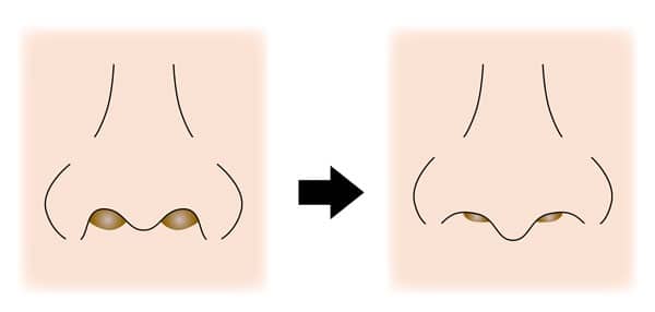 鼻孔縁挙上術変化のイメージ正面