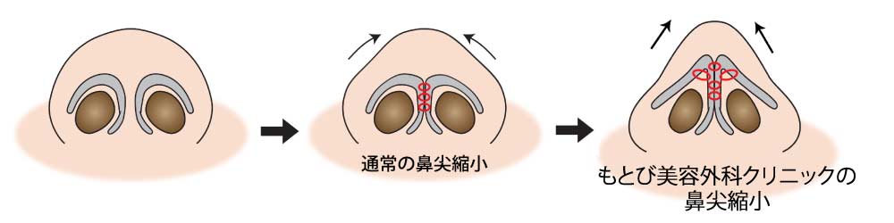 もとび美容外科クリニックの鼻尖縮小術と通常の鼻尖縮小との違い