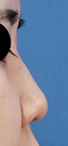 切らない鼻尖延長（ミスコ）、鼻ヒアルロン酸（クレイヴェルコントア）　１週間後　右側面のBefore写真