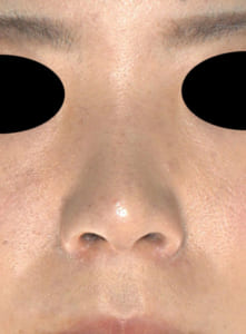 コラム　鼻尖軟骨移植手術後症例写真１