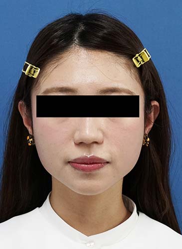 ゼオミン強力小顔ボトックス　１ヶ月後のBefore写真