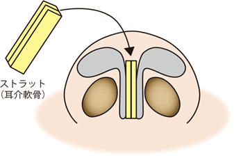 鼻尖軟骨移植　ストラット図