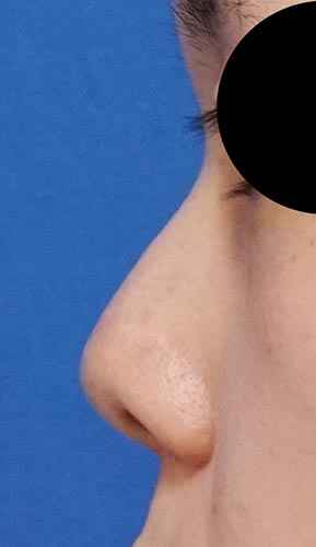 鼻尖縮小(3D法)、軟骨移植、ストラット　半年後　左側面のBefore写真