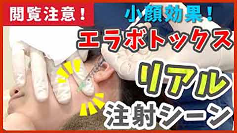 エラボトックス注射動画
