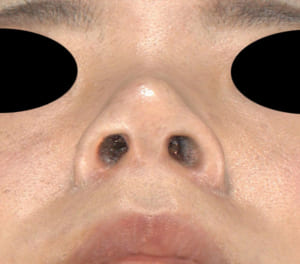 コラム　鼻尖軟骨移植手術後症例写真3