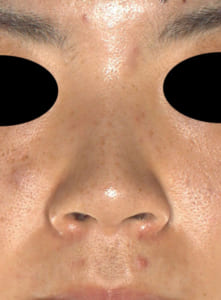 コラム　鼻尖軟骨移植手術前症例写真１