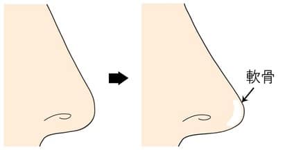 鼻尖軟骨移植　鼻先軟骨図