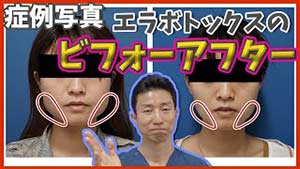 エラボトックスの症例写真ビフォーアフター　動画解説