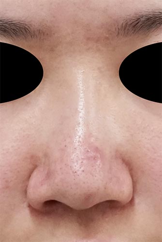 鼻尖縮小、鼻翼縮小（内側＋外側）　手術前　正面