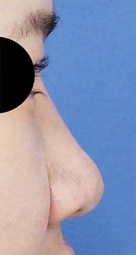 鼻ヒアルロン酸（クレヴィエル）　１週間後　右側面のAfterの写真
