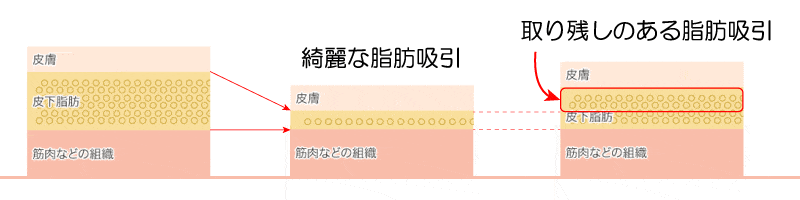 小顔脂肪吸引　リスク　取り残し