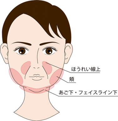 顔の脂肪吸引箇所