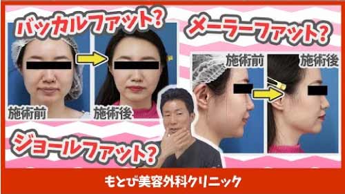 小顔脂肪吸引　ジョーるふぁっと　youtubeサムネイル
