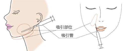 小顔脂肪吸引　リスク失敗　脂肪吸引方法