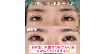 目頭切開リドレープ法の手術直後の様子をご覧ください