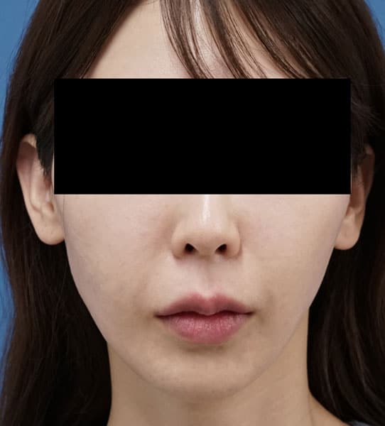 唇ヒアルロン酸　処置直後　顔全体のAfterの写真