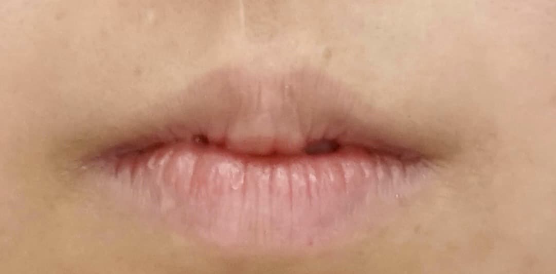 唇のヒアルロン酸のBefore写真