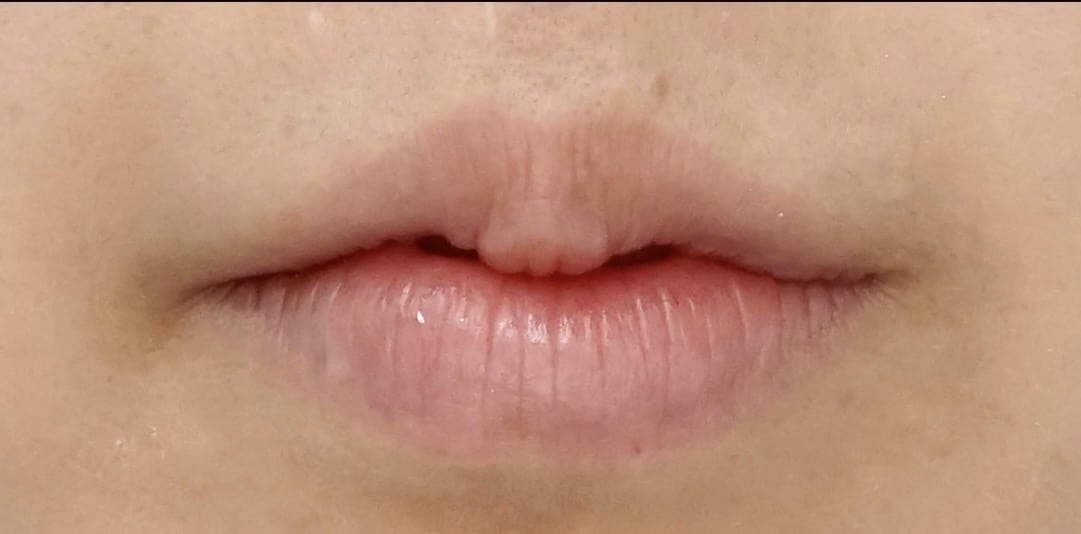 唇のヒアルロン酸のAfterの写真