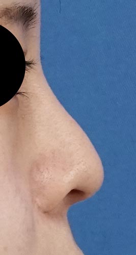 切らない鼻尖延長（ミスコ８本）　１週間後　右側面のBefore写真