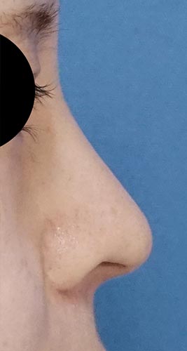 切らない鼻尖延長（ミスコ８本）　１週間後　右側面のAfterの写真