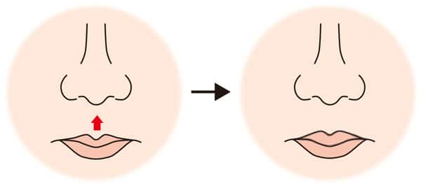 上口唇厚くする鼻下長短縮イメージ