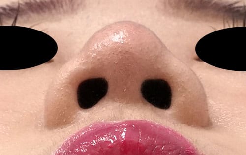 鼻尖縮小（3D法）＋軟骨移植＋ストラット　６か月後 　下からのAfterの写真