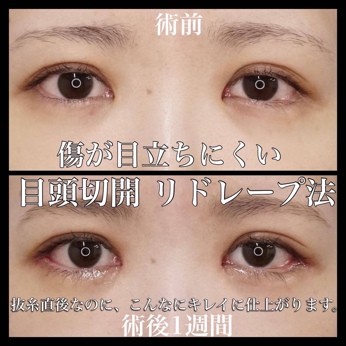目頭切開 リドレープ法 もとび美容外科クリニック